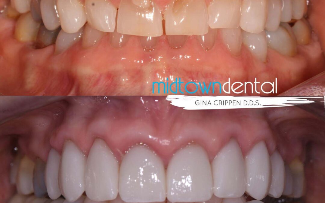 Cerec Veneers Before & After