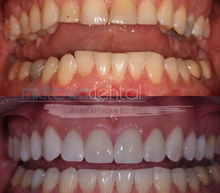 Cerec Veneer Before & After