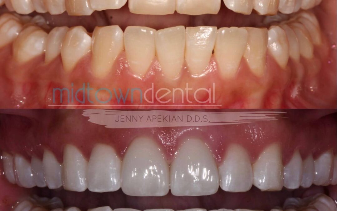 Cerec Veneers with Gum Lift Before & After